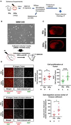 Radiation Induced Metabolic Alterations Associate With Tumor Aggressiveness and Poor Outcome in Glioblastoma